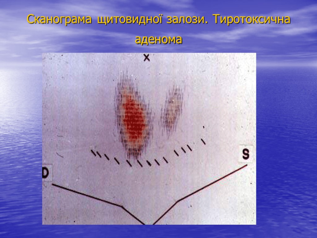 Сканограма щитовидної залози. Тиротоксична аденома